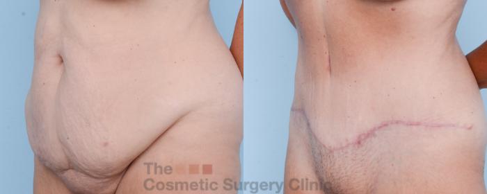Before & After Tummy Tuck Case 586 View #3 View in Waterloo, Ontario