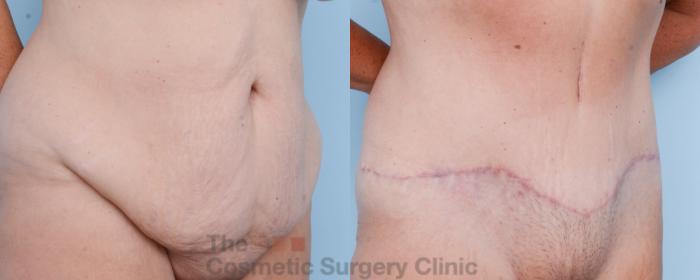 Before & After Tummy Tuck Case 586 View #4 View in Waterloo, Ontario