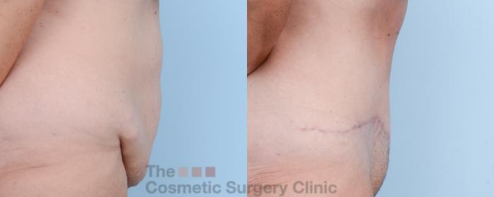 Before & After Tummy Tuck Case 586 View #5 View in Waterloo, Ontario