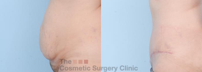 Before & After Tummy Tuck Case 608 View #2 View in Waterloo, Ontario