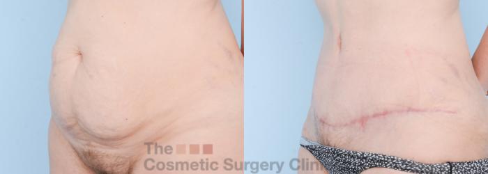 Before & After Tummy Tuck Case 608 View #3 View in Waterloo, Ontario