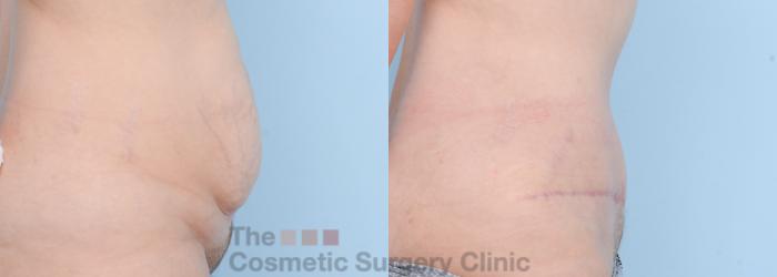 Before & After Tummy Tuck Case 608 View #5 View in Waterloo, Ontario