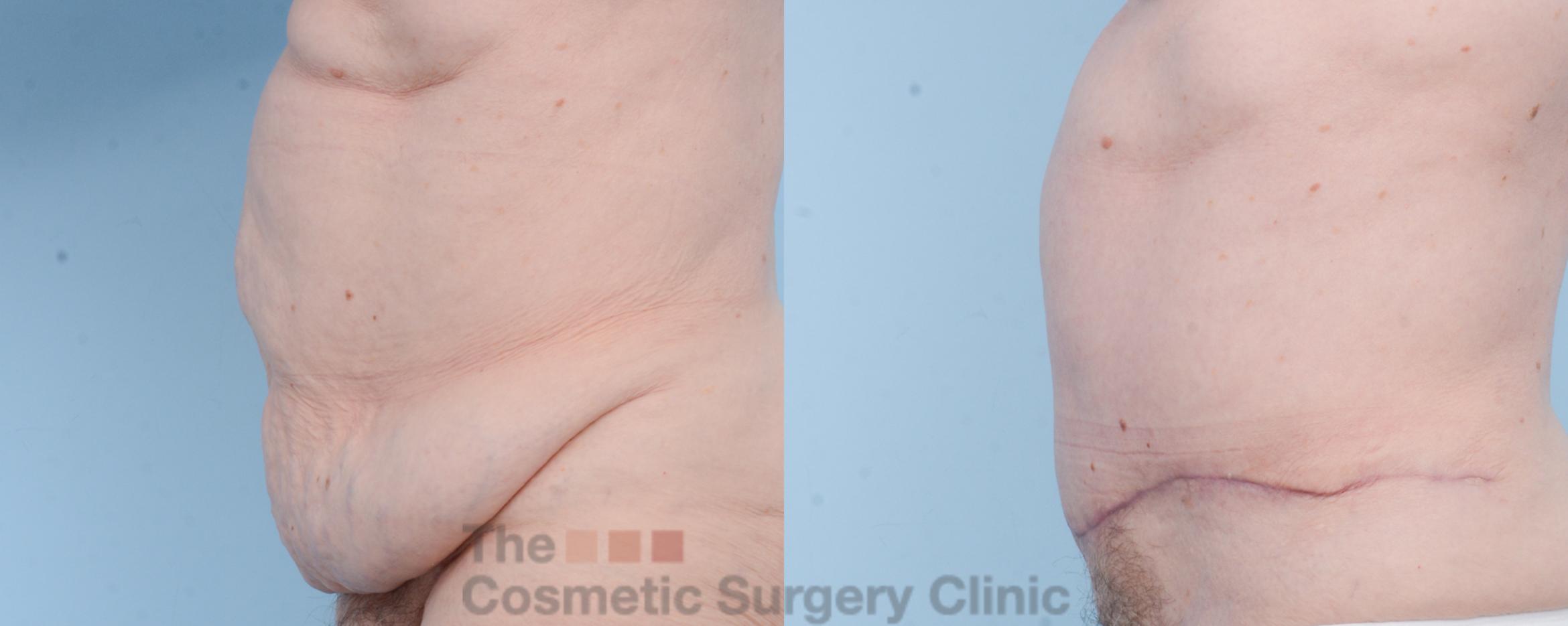 Before & After Tummy Tuck Case 714 View #2 View in Waterloo, Ontario