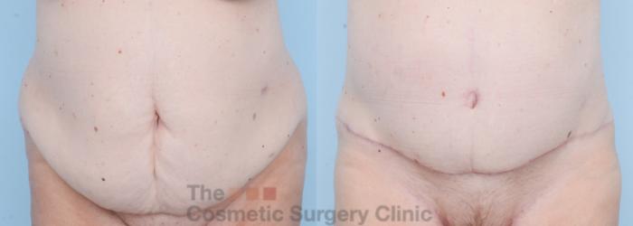 Before & After Tummy Tuck Case 732 Front View in Waterloo, Ontario