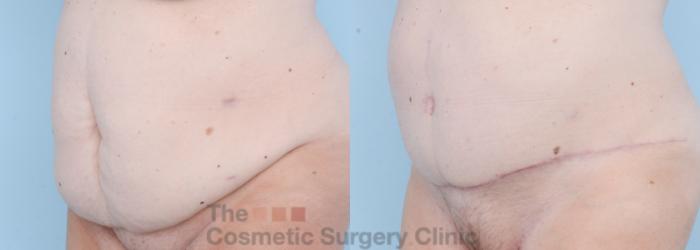 Before & After Tummy Tuck Case 732 Left Oblique View in Waterloo, Ontario