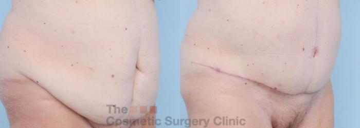 Before & After Tummy Tuck Case 732 Right Oblique View in Waterloo, Ontario