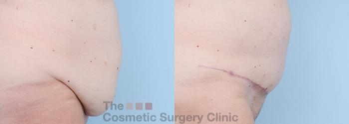 Before & After Tummy Tuck Case 732 Right Side View in Waterloo, Ontario