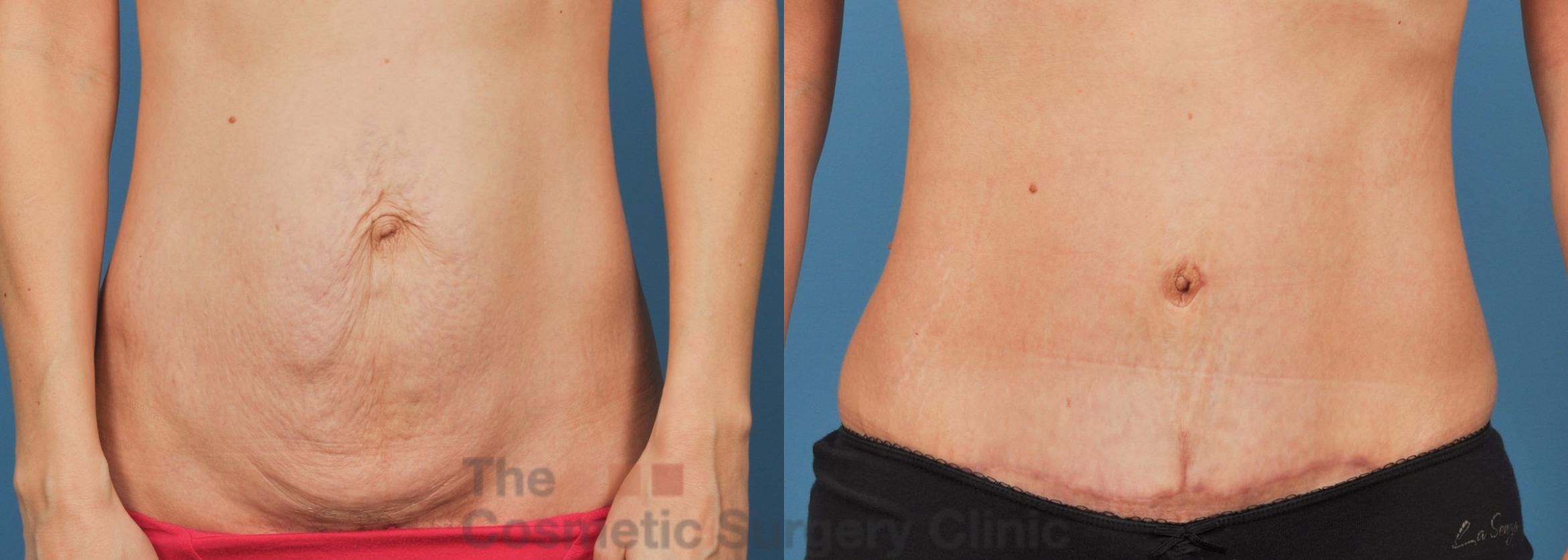 Before & After Tummy Tuck Case 738 Front View in Waterloo, Ontario