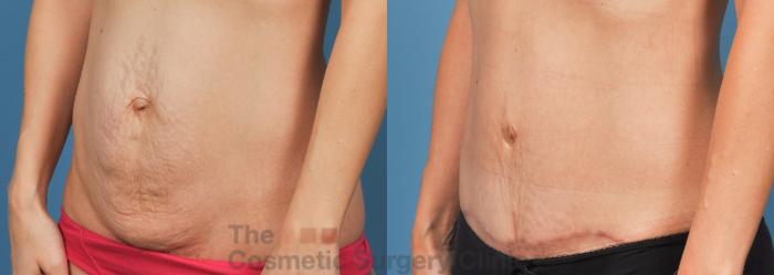 Before & After Tummy Tuck Case 738 Left Oblique View in Waterloo, Ontario