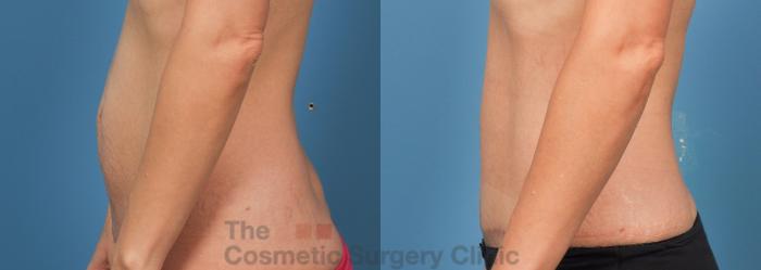 Before & After Tummy Tuck Case 738 Left Side View in Waterloo, Ontario