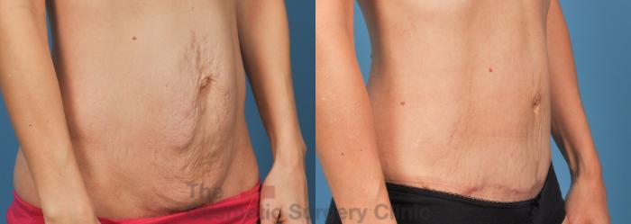 Before & After Tummy Tuck Case 738 Right Oblique View in Waterloo, Ontario
