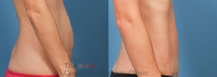Before & After Tummy Tuck Case 738 Right Side View in Waterloo, Ontario