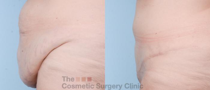 Before & After Tummy Tuck Case 781 Left Side View in Waterloo, Ontario