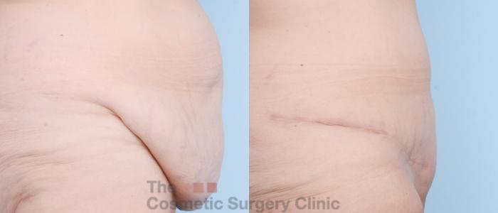Before & After Tummy Tuck Case 781 Right Side View in Waterloo, Ontario