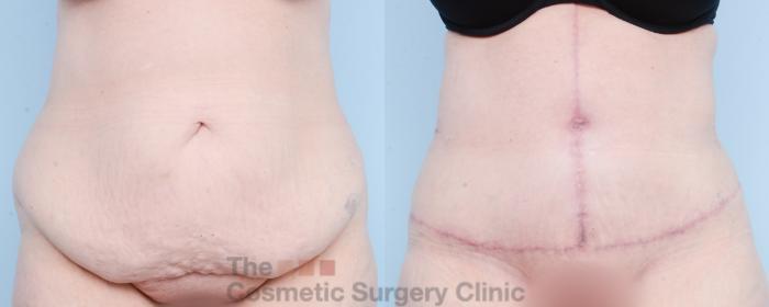Before & After Tummy Tuck Case 800 Front View in Waterloo, Ontario