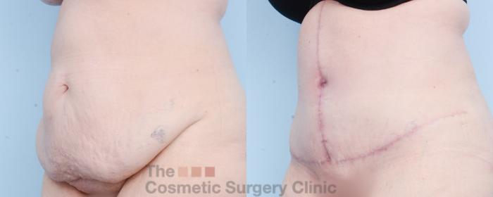 Before & After Tummy Tuck Case 800 Left Oblique View in Waterloo, Ontario