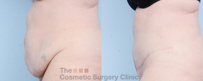 Before & After Tummy Tuck Case 800 Left Side View in Waterloo, Ontario
