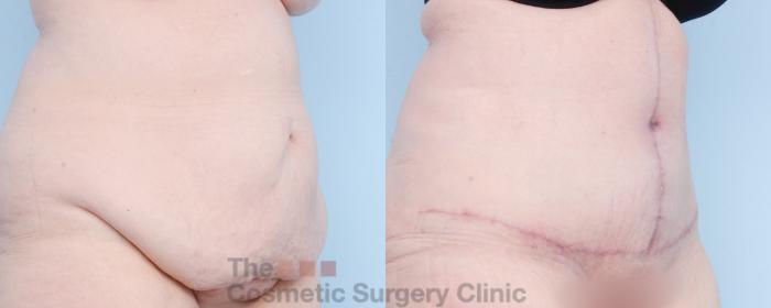 Before & After Tummy Tuck Case 800 Right Oblique View in Waterloo, Ontario