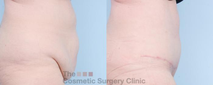 Before & After Tummy Tuck Case 800 Right Side View in Waterloo, Ontario