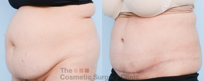 Before & After Tummy Tuck Case 804 Left Oblique View in Waterloo, Ontario