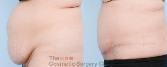 Before & After Tummy Tuck Case 804 Left Side View in Waterloo, Ontario