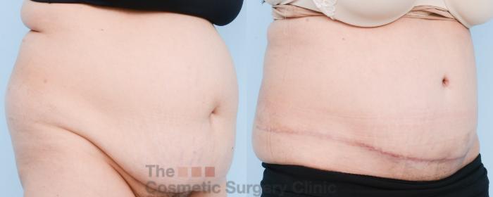 Before & After Tummy Tuck Case 804 Right Oblique View in Waterloo, Ontario