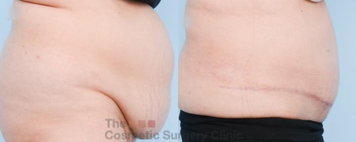Before & After Tummy Tuck Case 804 Right Side View in Waterloo, Ontario