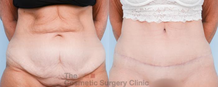Before & After Tummy Tuck Case 806 Front View in Waterloo, Ontario