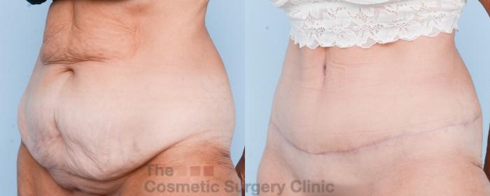 Before & After Tummy Tuck Case 806 Left Oblique View in Waterloo, Ontario
