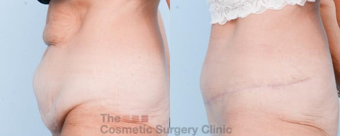 Before & After Tummy Tuck Case 806 Left Side View in Waterloo, Ontario