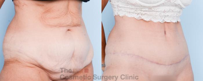Before & After Tummy Tuck Case 806 Right Oblique View in Waterloo, Ontario