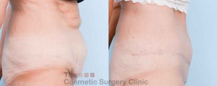 Before & After Tummy Tuck Case 806 Right Side View in Waterloo, Ontario