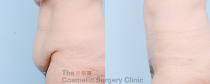 Before & After Tummy Tuck Case 807 Left Side View in Waterloo, Ontario