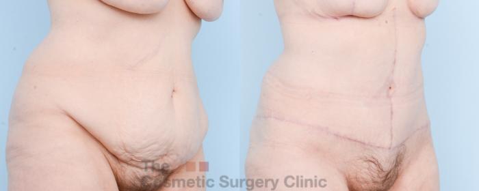 Before & After Tummy Tuck Case 807 Right Oblique View in Waterloo, Ontario