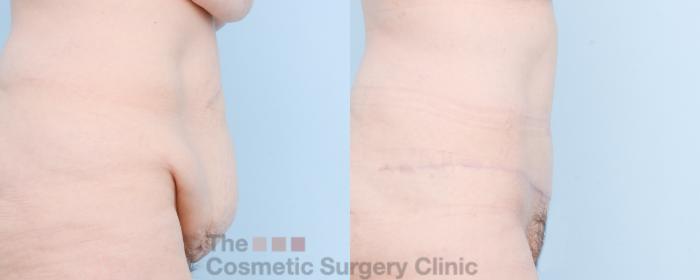 Before & After Tummy Tuck Case 807 Right Side View in Waterloo, Ontario