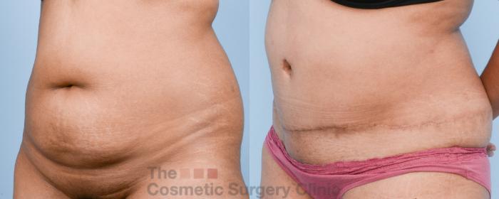 Before & After Tummy Tuck Case 813 Left Oblique View in Waterloo, Ontario