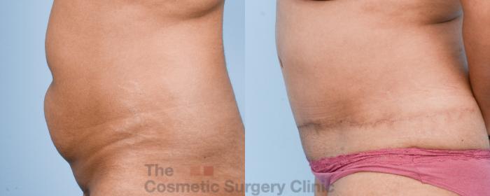 Before & After Tummy Tuck Case 813 Left Side View in Waterloo, Ontario