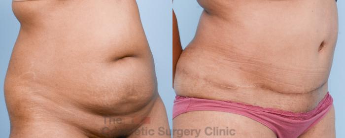 Before & After Tummy Tuck Case 813 Right Oblique View in Waterloo, Ontario