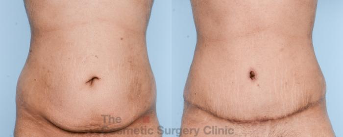 Before & After Tummy Tuck Case 816 Front View in Waterloo, Ontario