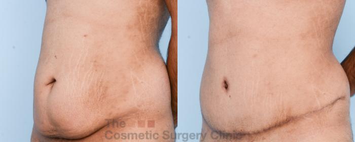 Before & After Tummy Tuck Case 816 Left Oblique View in Waterloo, Ontario