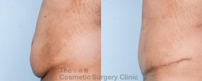 Before & After Tummy Tuck Case 816 Left Side View in Waterloo, Ontario