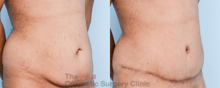 Before & After Tummy Tuck Case 816 Right Oblique View in Waterloo, Ontario