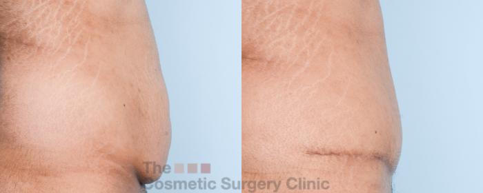 Before & After Tummy Tuck Case 816 Right Side View in Waterloo, Ontario