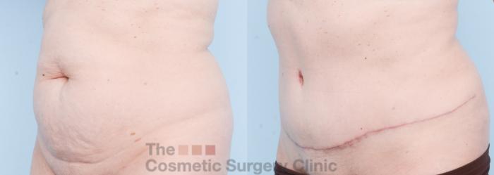 Before & After Tummy Tuck Case 817 Left Oblique View in Waterloo, Ontario