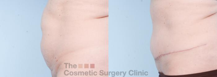Before & After Tummy Tuck Case 817 Left Side View in Waterloo, Ontario