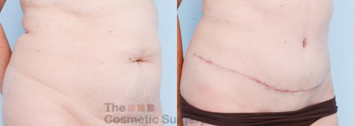 Before & After Tummy Tuck Case 817 Right Oblique View in Waterloo, Ontario