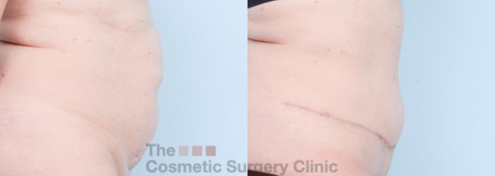 Before & After Tummy Tuck Case 817 Right Side View in Waterloo, Ontario
