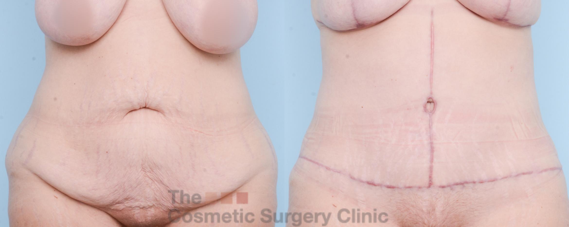 Before & After Tummy Tuck Case 825 Front View in Waterloo, Ontario