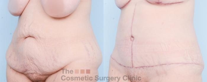Before & After Tummy Tuck Case 825 Left Oblique View in Waterloo, Ontario