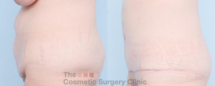 Before & After Tummy Tuck Case 825 Left Side View in Waterloo, Ontario